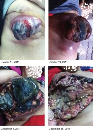 Figure 4 Tumor images after surgery.