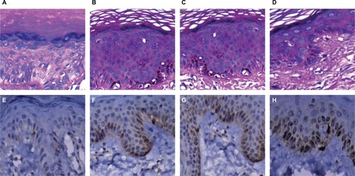 Figure 4 H&E staining and HMB45.