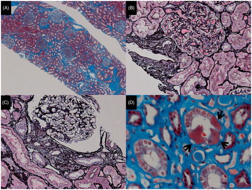 Figure 1. The light microscopic findings. (A) While globally sclerosed glomeruli and collapsed glomeruli were observed, the other glomeruli showed an almost normal appearance (Masson trichrome stain, original magnification ×40). (B) This glomerulus looks normal. However, the vascular smooth muscle cells are disorganized and enlarged (PAM-HE stain, original magnification ×200). (C) This glomerulus also looks normal, while the myocytes of the afferent arteriole are enlarged and their endothelium has slight hyalinosis (PAM-HE stain, original magnification ×200). (D) Granular swollen epithelial cells are indicated by arrows (Masson trichrome stain, original magnification ×400).