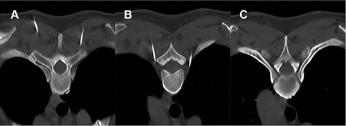 Figure 2 CT-guided radiofrequency thermocoagulation of the thoracic sympathetic nerve. (A–C) dynamic demonstrations of the puncture needle from the skin into the anterior margin of the small head of the fourth costal bone.