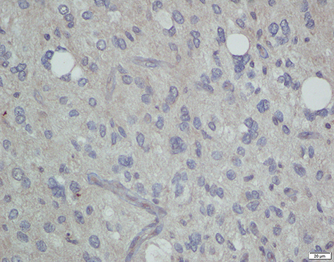 Figure 2 Another tumor sample with IDH wild-type (patient with glioblastoma).