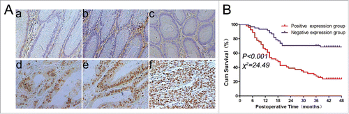 Figure 1. TPX2 overexpression in gastric cancer tissues and its association with the survival of gastric cancer patients. (A) Immunohistochemical staining of TPX2 protein in gastric tissues. TPX2 protein is localized in the tumor cell nuclei (d–f), whereas TPX2 protein is negative in the normal gastric mucosa (a–c). (B) Kaplan–Meier curves stratified by TPX2 expression levels in gastric cancer. The data showed that patients with higher TPX2-expressing tumors had a shorter overall survival, whereas patients with lower TPX2-expressing tumors had a better overall survival (P < 0.001).