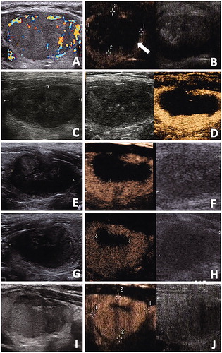 Figure 5. The conventional US and CEUS images of a 48-year-old male with a benign thyroid nodule. (A) Before RFA, a solid thyroid nodule located in the right thyroid lobe with an initial volume of 22.27 ml. Color Doppler showed the vascularity was grade 3. (B) CEUS performed immediately after RFA showed a lack of enhancement on the treated area(arrow). (C, D) At one months after RFA, conventional US showed the treated nodule began to shrink and total volume(Vt) was 5.28ml. CEUS showed the treated nodule was divided into the centrally non-enhancement area(ablated volume, Va) and peripheral iso-enhancement area(vital volume, Vv). Va was 2.59ml and Vv was 2.69ml. RVR was 50.95%. (E, F) At 3 months after RFA, conventional US showed Vt was 3.48ml and the echogenicity of nodule was heterogeneous. Va decreased to 1.11ml on CEUS and Vv was 2.37ml. (G, H) At 6 months after RFA, conventional US and CEUS showed Vt decreased to 2.89 ml and Va decreased to 0.27ml, respectively. However, Vv began to enlarge to 2.62ml.(I, J) At 12 months after RFA, conventional US showed nodule regrowth and Vt was 4.34ml. Va decreased to 0.20ml on CEUS and thus Vv increase also occurred and Vv was 4.13ml.