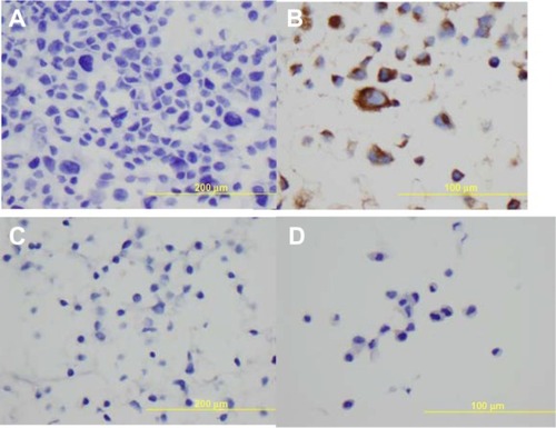 Figure 3 Immunohistochemical staining with Napsin A on paraffin cell blocks for all the four lung adenocarcinoma cell lines.