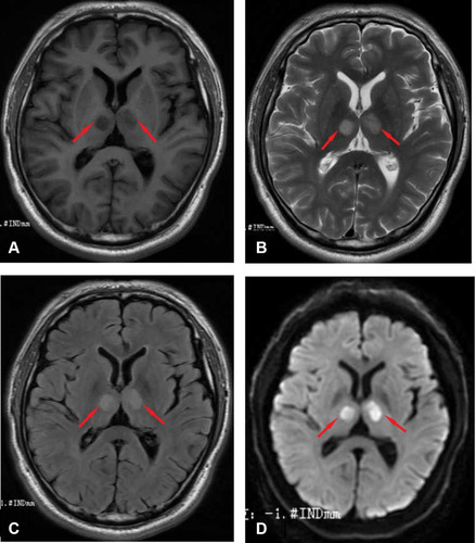 Figure 4 (A) T1* gradient echo MRI. Images show abnormal low signal bilateral paramedian thalamic lesions (arrows). (B) T2* gradient echo MRI. Images show abnormal hyperintense bilateral paramedian thalamic lesions (arrows). (C) Fluid attenuated inversion recovery echo MRI. Images show abnormal hyperintense bilateral paramedian thalamic lesions (arrows). (D) Diffusion-weighted axial MR showing diffusion restriction of the bilateral paramedian thalamus (arrows).