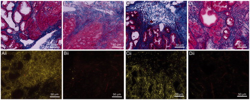 Figure 4. Representative images of serial sections stained with Masson’s trichrome (i) and fluorescent imaging (ii). Images demonstrate the distribution of doxorubicin and blood vessels within pancreatic tumours treated with LTSL-Dox + MR-HIFU (A); LTSL alone (B); DOX + MR-HIFU (C) OR Dox alone (D).