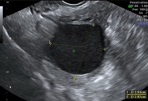 Figure 1 Transvaginal ultrasonography of the endometrioma.