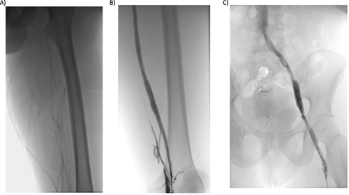 Figure 3 Phlebography from the posterior tibial vein. (A) Before rt-PA infusion: occupation of the deep tibial, popliteal and femoral venous territory, with little drainage through the superficial vein territory; B and (C) Following rt-PA infusion: permeability of the posterior tibial, popliteal, femoral, iliac and cava venous system.