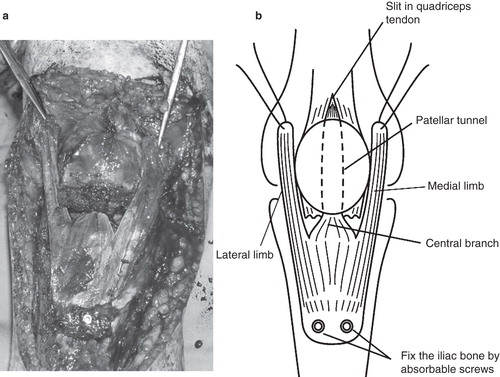 Figure 3. Reconstruction of the patellar tendon using the fascia lata attached to the iliac bone: intraoperative photo (a) and schematic drawing (b). The central branch of the graft was passed through an 8–9 mm longitudinal tunnel and then through a slit in the quadriceps tendon.