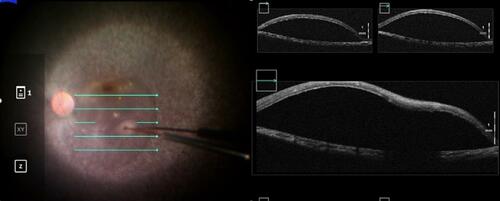 Figure 5 Intraoperative optical coherence tomography imaging can be used to guide the formation of a subretinal bleb of voretigene neparvovec and confirm its proper localization in the subretinal space.