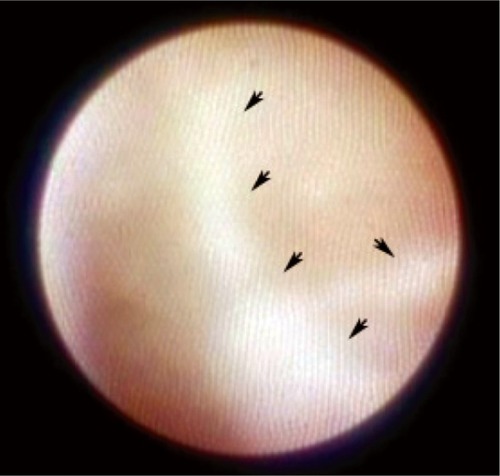 Figure 3 Dacryoendoscopic image showing fibrosis in the lacrimal sac (arrows). The lumen is to the left of the fibrosis.