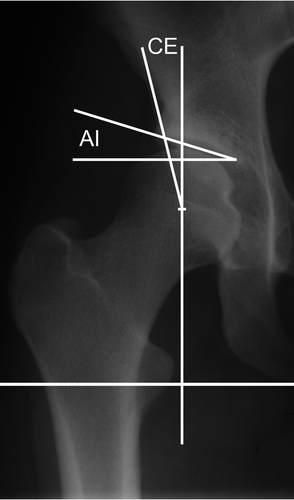 Figure 2A. Part of an anteroposterior pelvic radiograph showing the right hip with constructed center-edge (CE) and acetabular index (AI) angles.