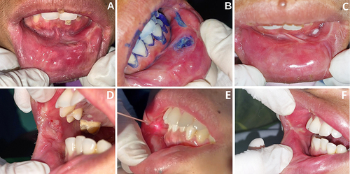 Figure 2 A 38-year-old woman with chronic oral ulcer. (A) Ulcer on left labial and buccal mucosa. (B) Toluidine blue examination: no malignancy possibilities. (C) On the next visit (2 months), ulcer condition after histopathological biopsy along with stricture release procedure. (D) Ulcer on the right buccal mucosa. (E) Application of PBM to ulcers. (F) Lesion condition in the fourth visit (day 28) showed cicatricial/fibrotic tissue formation.