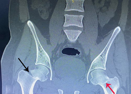Figure 2 A coronal view of a computerized tomography (CT) shows an intracapsular displaced fracture in the neck of the right femur (black arrow). On the left femur neck, the nondisplaced fracture is clearly seen (red arrow).