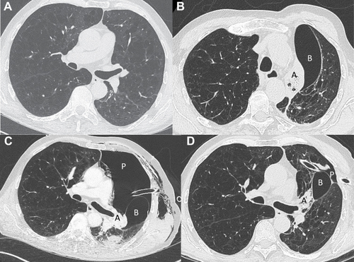 Figure 3 Chest CT evolution (patient 3). (A) Chest CT performed before valves insertion characterized by heterogeneous emphysema. (B) Chest CT performed one day after valves insertion in the left upper lobe (LUL). There is a complete atelectasis (A) of the LUL and occurrence of a bulla (B). (C) Chest CT performed six days after valves insertion with a pneumothorax (P) drained by a chest tube, the bulla (B) and the atelectasis (A) of the LUL. (D) Chest CT performed 30 days after valves insertion with decrease of the size of the pneumothorax (P) and the bulla (B). Only partial atelectasis (A) persisted in the LUL.