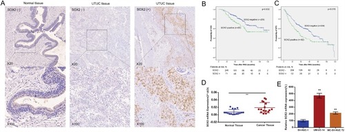 Figure 2 SOX2 expression was upregulated in UTUC. The relative expression levels of SOX2 were detected using immunohistochemistry and real-time qPCR. (A): Representative IHC images are shown. (B): CSS curves were stratified by SOX2 expression. (C): DFS curves were stratified by SOX2 expression. (D). The relative expression level of SOX2 was significantly higher in UTUC tissue samples than in matched normal tissue samples. (E). SOX2 expression levels were higher in UTUC cell lines than in a normal urothelial cell line. **p < 0.01.