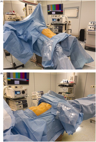 Figure 1. (A, B) Reverse-Trendelenburg (head-up tilt) and Trendelenburg positioning are essential for performing a left colectomy through the laparoscopic approach.