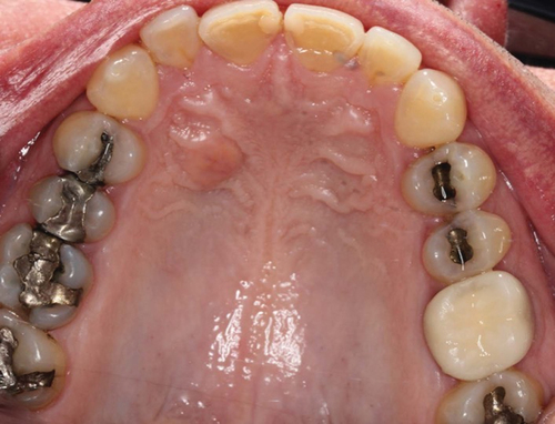 Figure 1. Clinical photo demonstrating anterior palatal soft tissue lesion filling the space between palatal rugae medial to the right maxillary canine.