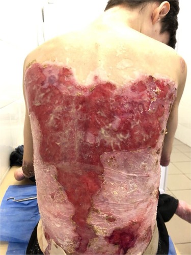 Figure 1 Appearance of lesions on the patient’s back on presentation.