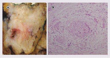 Figure 4. Pancreatic ductal adenocarcinoma. (A) Gross examination shows a 4.1 cm tumor in the head of the pancreas. The consistency is firm and the appearance after cross section is gray–white. (B) Microscopic examination reveals a moderately differentiated ductal adenocarcinoma with a poorly differentiated component. Infiltrating malignant glands are seen here embedded in a dense fibrotic stroma.