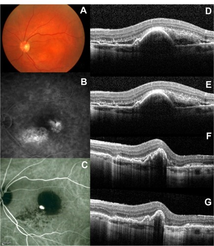 Figure 2 Selected case: A 72-year-old man was referred for decreased visual acuity in the left eye. Baseline examination, including (A) fundoscopy, (B) fluorescein angiography, (C) ICG angiography, and (D) macular OCT revealed a serous PED associated with exudative AMD. The baseline BCVA and PED height were 20/100 and 385 μm respectively. The same eye (E) at 3 months (BCVA: 20/80; PED height: 358 μm), (F) at 6 months (BCVA: 20/70; PED height: 297 μm), and (G) at 12 months (BCVA: 20/60; PED height: 251 μm) after the first ranibizumab injection.
