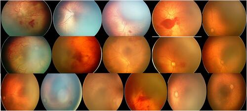 Figure 2 Retinal images of the patients with APROP.