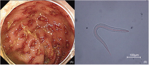 Figure 2. Exacerbation of colitis and a single larva isolated from an ulcerative lesion. (A) Follow-up colonoscopy revealed exacerbation of the inflammatory mucosal lesions in response to administration of golimumab and an intermediate dose of corticosteroid. Numerous ulcerative lesions with white plaques that extended from the splenic flexure to the descending colon were detected. (B) A larva of Strogyloides stercolaris isolated from an ulcerative lesion (lesions circled with broken lines in A).