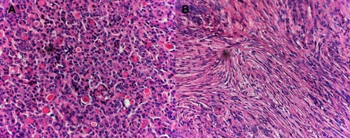 Figure 2 Histopathological examinations of the two sporadic multiple meningiomas. (A) The right frontal tumor cells showed syncytium-like appearance with unclear boundaries. Cells were arranged in large lobulated structures. Some cells were partially epithelial-differentiated and the intraepithelial microgland contained eosinophilic substances. Pathological diagnosis was secretory meningioma (WHO grade I). (B) The right parietal tumor showed spindle cells with bland nuclei arranged in storiform pattern, with calcification in some adipose tissues. Pathological diagnosis was fibrous meningioma (WHO grade I).