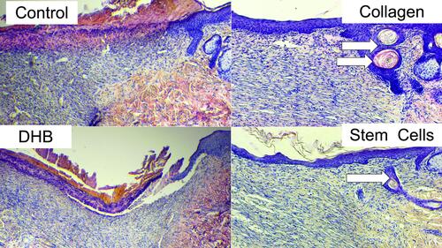 Figure 6 The wound edge view in different groups on the 14th day of the study. Arrows indicate the growth buds of the hair follicles. Hematoxylin–eosin staining, magnification x100.