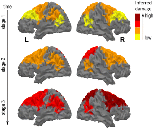 Figure 3. Longitudinal mapping of degeneration spreading in patient CG. Colored areas represent the brain loci of degeneration that were inferred from CG’s cognitive phenotype and by considering well-known brain anatomical-functional correlations found in the literature. The reported stages refer to the successive evaluations performed in the study.