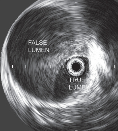 Figure 5 Intravascular imaging of aortic dissection.