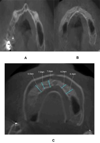 Figure 7 CT after 4 months: (A) preoperative width, (B) postoperative change in width, (C) measurements of postoperative augmentation.