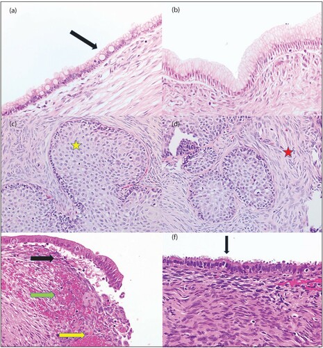 Figure 3: H&E photomicrographs of benign epithelial ovarian neoplasms; original magnification 400x. A and B are from a mucinous cystadenoma. A shows a single layer of epithelium with goblet cells (arrow) whilst B shows a gastric epithelial lining. C and D demonstrate a benign Brenner tumour. Bland transitional-type epithelium (yellow star) is set in a prominent fibrous stroma (red star). E shows an endometriotic cyst/endometrioma lined by columnar epithelium with underlying endometrial stroma (black arrow), haemorrhage (green arrow) and haemosiderin (yellow arrow). F demonstrates a serous cystadenoma lined by ciliated tubal-type epithelium (arrow).