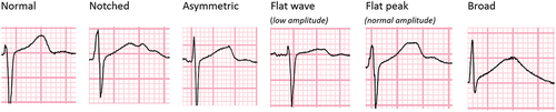 Figure 1. Examples of the different T-wave morphology that were categorized from participants in the STREAM stage 1 trial.