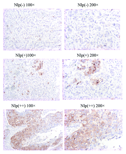 Figure 5. Nlp expression in human breast cancer tissues. The samples derived from breast cancer patients were collected and subjected to immunohistochemical staining with anti-Nlp antibody, which indicates Nlp mainly expressed in cytoplasm.
