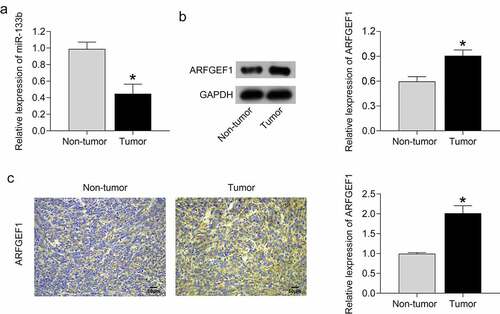 Figure 4. MiR-133b expression was decreased and ARFGEF1 expressed was increased in patients with cervical cancer.