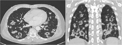 Figure 1. Computed tomography of the chest post-COVID-19 mRNA-1273 vaccine demonstrating multiple subpleural and peribronchovascular nodular opacities. Most findings show reverse halo sign with peripheral rim of dense consolidation and central ground-glass opacity, more prominent in the lower lung zones.