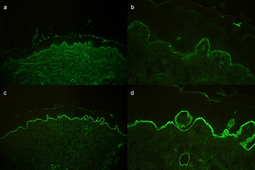 Figure 2 Direct immunofluorescence, (a) mixed linear and granular deposition of IgG along dermo-epidermal junction (DEJ), (b) Granular deposition of IgM along DEJ and superficial blood vessel, (c and d) mixed linear and granular deposition the along DEJ and perifollicular granular deposition of C3.