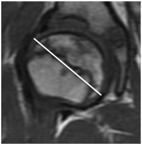 Figure 8C. At 2 years and 8 months. An 11% increase in the maximum diameter. Almost stage IV.