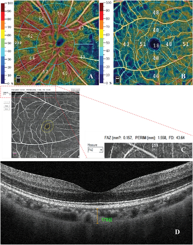Figure 2. Parameters by OCTA. A) Illustrations of the PVD and IVD; B) Illustration of the MVD. Fovea, parafovea and perifovea (central circle with 0.5 mm radius, around the fovea with inner and outer diameters of 1 mm and 3 mm); C) FAZ area, AI, FD; D. The value of SFCT was measured manually.
