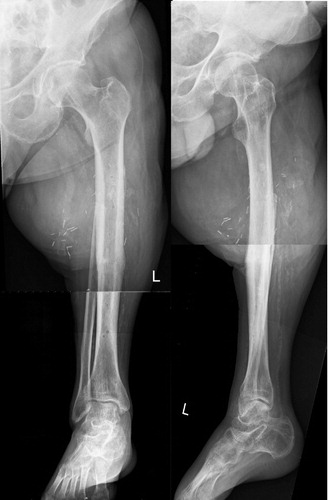 Figure 4.  Femoro-tibial fusion at last follow-up.