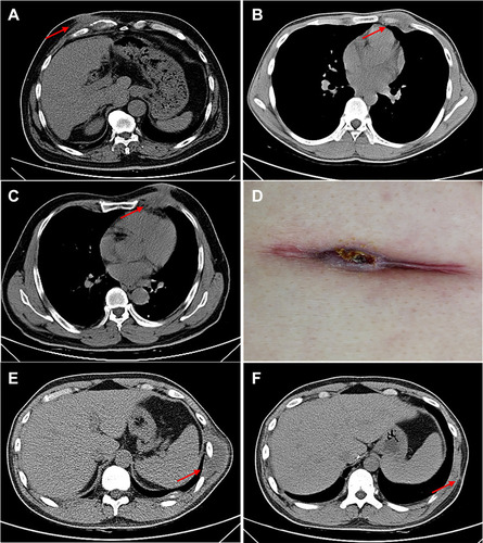 Figure 1 Imaging findings of chest wall tuberculosis (TB). (A) Sinus formation caused by TB lesions piercing the chest wall. (B) Chest wall TB lesion breached through the intercostal muscle to form a dumbbell-like abscess. (C) In some patients with chest wall TB, the lesion showed no signs of healing after surgical treatment (no anti-TB treatment). (D) Secretion at the incision site. (E) Chest wall TB lesion only formed in local thoracic masses. (F) After the patient depicted in panel E underwent chest wall lesion removal, his lesion showed no residue and the wound healed well.