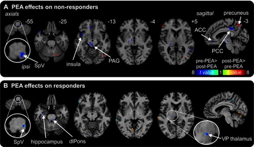 Figure 2 Effects of palmitoylethanolamide (PEA) on infra-slow oscillations. (A) Differences in fractional amplitude of low-frequency fluctuations (fALFF) pre-PEA compared with post-PEA treatment on non-responders. Significant increases (hot color scale) and decreases (cool color scale) in fALFF are overlaid onto a series of axial and sagittal T1-weighted anatomical slices. Slice locations in Montreal Neurological Institute space are indicated at the top right of each slice. (B) Differences in fALFF pre-PEA compared with post-PEA treatment in responders. Note that fALFF decreased in the spinal trigeminal nucleus (SpV) in both responders and non-responders and in the ventroposterior (VP) thalamus only in responders.
