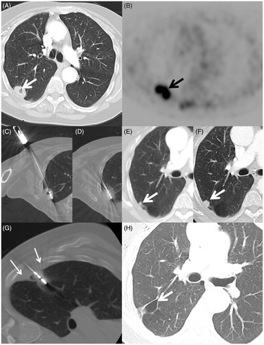 Figure 2. A 70-year-old woman with a 45 packs per year smoking history and previous lung cancer surgery on the left had a mass in the right lung discovered on chest X-ray. (A) Axial CT scan shows a 2.7-cm elliptical mass with central cavitation abutting the visceral pleural surface (arrow). (B) Axial FDG PET image shows intense uptake with standard uptake value of 10.9 (arrow) with no regional or distant disease (Stage IB). Biopsy confirmed squamous cell carcinoma and she was referred for ablation due to her high operative risk. (C) Axial image during the microwave ablation shows satisfactory placement of the antenna within the centre of the mass parallel to the long axis (arrow) and (D) after 10 min of heating with 65 W a circumferential ground glass halo appears; (E) 10- and (F) 14-month follow-up CT scans show a small growing nodule adjacent to the ablation zone consistent with recurrence (arrow). The patient returned for retreatment. (G) Axial CT image shows MW antenna in the recurrence. Extrapleural lidocaine was used to protect the chest wall (small arrows) (H) Axial CT image 30 months after initial ablation shows an air filled cavity and no recurrence at the treatment site (arrow).