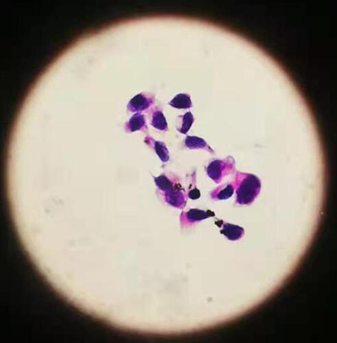 Figure 4 Lumbar puncture indicated positive cytology of cerebrospinal fluid (at high magnification 10 * 40).