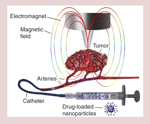 Figure 2. Magnetic drug targeting for cancer therapy.Biocompatible, stabilized superparamagnetic iron oxide nanoparticles are loaded with a chemotherapeutic drug, for example, mitoxantrone. The drug-loaded superparamagnetic iron oxide nanoparticles are administered intra-arterially via a catheter in the vicinity of a solid tumor into the vasculature supplying it, while a strong magnetic field is placed over the tumor area. Due to the magnetic force, the superparamagnetic iron oxide nanoparticles accumulate in the tumor area leading to a local drug dose, which is a multitude of what can be reached by commonly used intravenous chemotherapy. Simultaneously, the chemotherapeutic burden of the somatic tissue is substantially reduced.