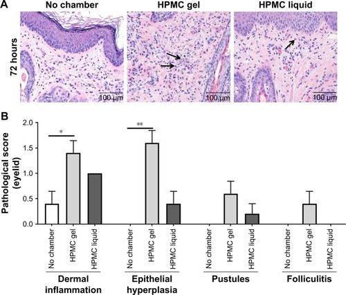 Figure 6 Histological analysis of guinea pig eyelid skin. Representative images of hematoxylin and eosin stained skin sections (A). Comparison of key pathology observations between treatment groups (B). Arrows indicate heterophilic inflammatory cells. Significant differences in dermal inflammation and epithelial hyperplasia were observed in scored eyelid sections between the HPMC gel treated groups and untreated controls. *P<0.05; **P<0.005.
