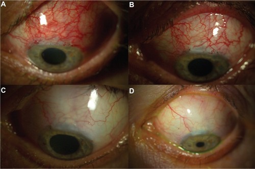 Figure 2 Unsuccessful treatment of early bleb failure with topical bevacizumab in patient 7. (A) Flat and injected bleb prior to bevacizumab application, (B) 7 days after topical administration of bevacizumab, (C) 2 months after topical administration of bevacizumab, and (D) 6 months after topical administration of bevacizumab, revealing a pale, flat, and nonfunctional bleb.