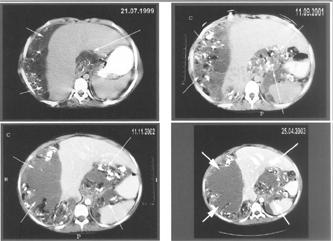 4 CT scans with contrast enhancement obtained before initiation of interferon therapy and during the course of interferon therapy, showing from moderate to significant amounts of ascites flanking the liver and spleen. Note some tiny calcifications and a few foci of soft tissue attenuation within the peritoneal fluid.