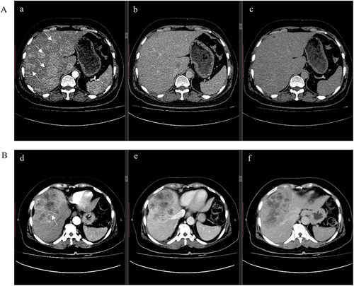 Figure 2 Computed tomography (CT) of Multifocal HCC vs Solitary HCC. (A) CT post-contrast axial a: arterial-phase b: portal venous phase and c: delayed phase images. Innumerable arterially enhancing hepatic lesions of variable sizes are seen demonstrating washout on the portal venous phase, consistent with multifocal HCC. (B); CT post-contrast d: arterial-phase e: portal venous phase and f: delayed phase images, showing relatively circumscribed centrally necrotic mass measuring 8.4×13.9 cm demonstrating peripheral arterial enhancement with venous washout and an enhancing pseudo capsule; this is centered in hepatic segments 4, 5 and 8, and approaches the capsule. Imaging features are compatible with solitary HCC.